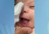 Bebê nasce com dois dentes e faz sucesso em hospital de Valadares