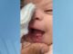 Bebê nasce com dois dentes e faz sucesso em hospital de Valadares