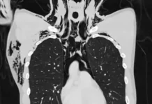 Rapaz de 20 anos é internado em UTI com condição pulmonar rara após se masturbar