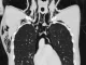 Rapaz de 20 anos é internado em UTI com condição pulmonar rara após se masturbar