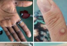 Governo confirma três casos de varíola do macaco em BH