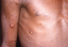 OMS declara emergência global de saúde para tentar conter surto de varíola do macaco