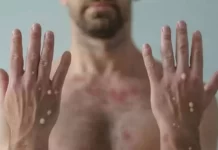 Saúde confirma primeiro caso de Varíola dos Macacos em Itabira