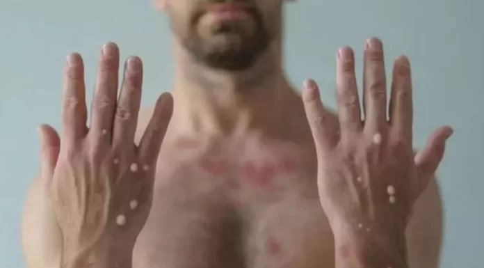 Saúde confirma primeiro caso de Varíola dos Macacos em Itabira