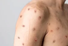 Varíola dos macacos: Minas Gerais passa dos 100 casos confirmados