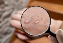 Brasil ultrapassa 4 mil casos registrados de varíola dos